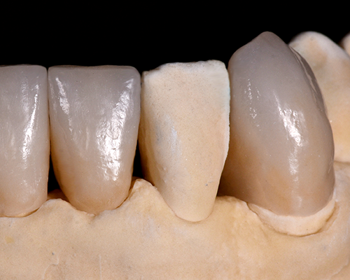 Cosmetic Ceramics UK | Kent | Digital Dentistry | Cosmetic Dentistry | Crowns & Bridges | Implants | Metal Free Dentistry